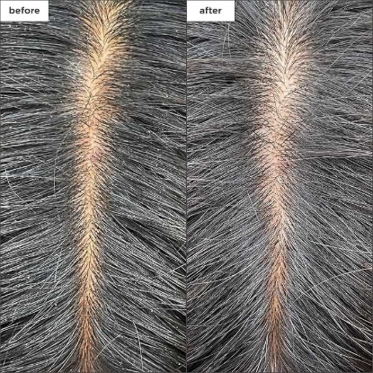Picture of Briogeo Scalp Revival Charcoal + Tea Tree Cooling Hydration Scalp Mask 177ml