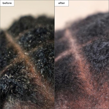 Picture of Briogeo Scalp Revival Charcoal + Tea Tree Scalp Treatment 30ml