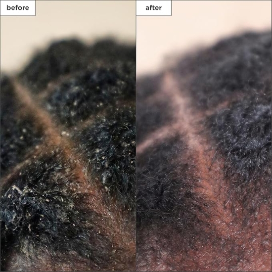 Picture of Briogeo Scalp Revival Charcoal + Tea Tree Scalp Treatment 30ml